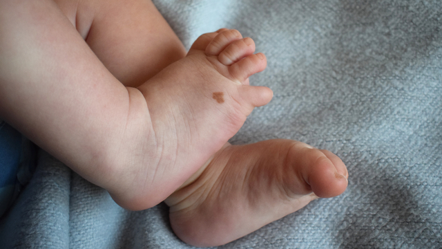 Ilustrasi tahi lalat pada bayi. Foto: Shutter Stock