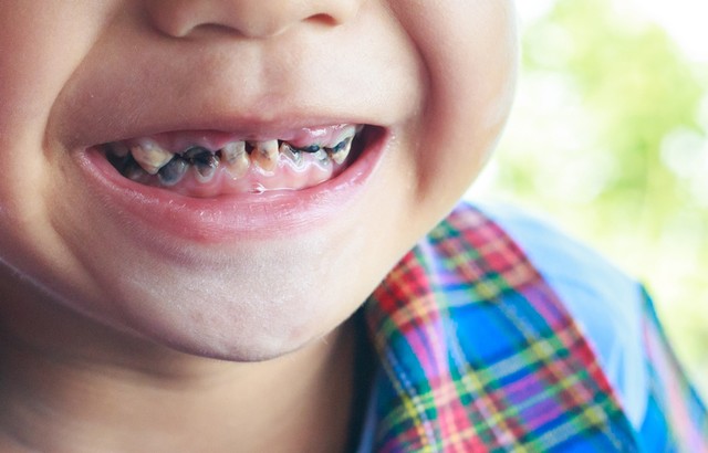 10 Penyebab Umum Kerusakan Gigi Anak (4908)