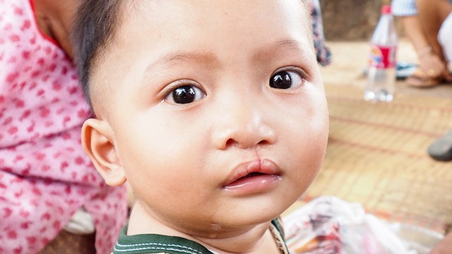 Ilustrasi anak bibir sumbing. Foto: Shutter Stock