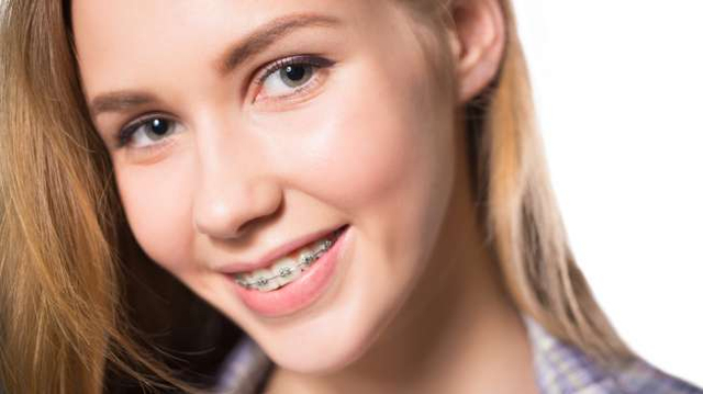 Ilustrasi memakai kawat gigi alias behel. Foto: Shutterstock.