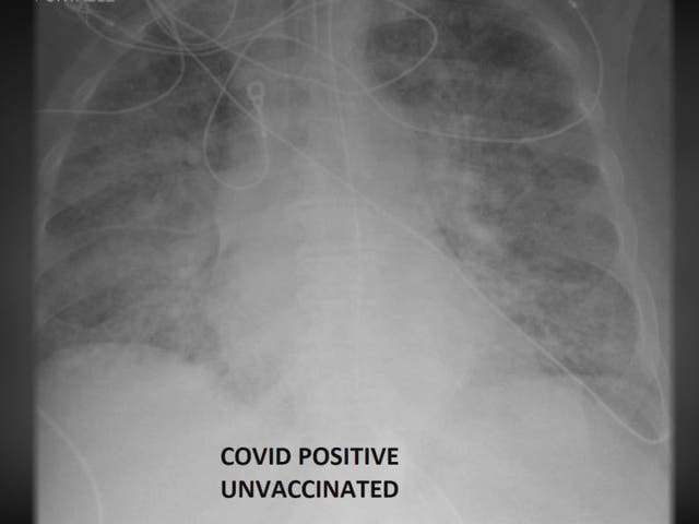 Foto Perbedaan Kondisi Paruparu Pasien Covid yang Sudah