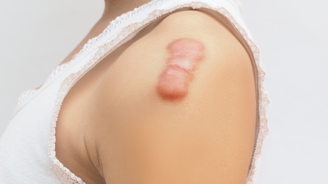 Ilustrasi luka pada kulit perempuan. Foto: Shutter Stock