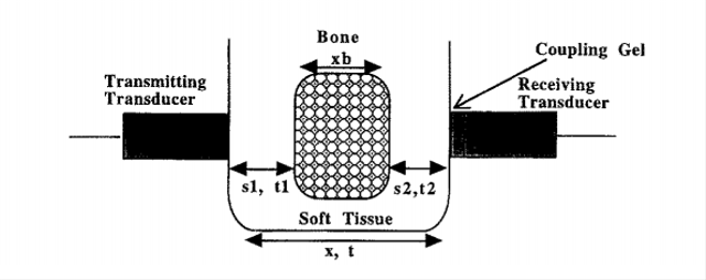 Konfigurasi pengukuran kepadatan tulang calcaneus dengan ultrasonik. Sumber: Sumber: Njeh, C.F., Boivin, C.M., dan Langton, C.M., “The Role of Ultrasound in the Assessment of Osteoporosis: A Review”. Osteoporosis International, vol. 7, 7-22, 1997.