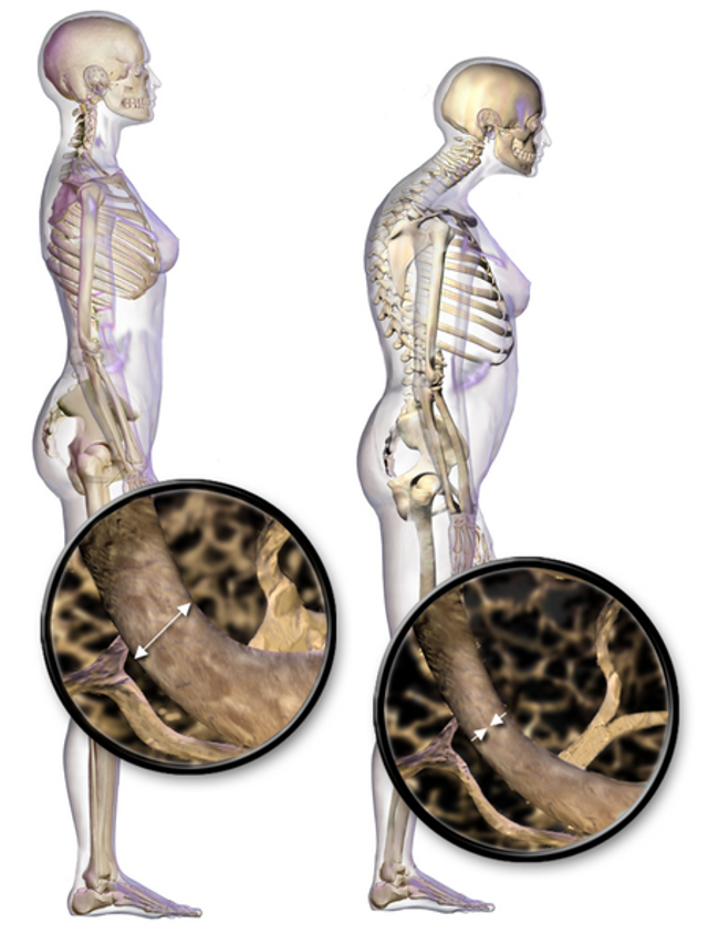 Perbandingan postur normal dan postur penderita osteoporosis. Sumber: Blausen.com staff (2014). "Medical gallery of Blausen Medical 2014". WikiJournal of Medicine 1 (2). DOI:10.15347/wjm/2014.010. ISSN 2002-4436. (Wikipedia).