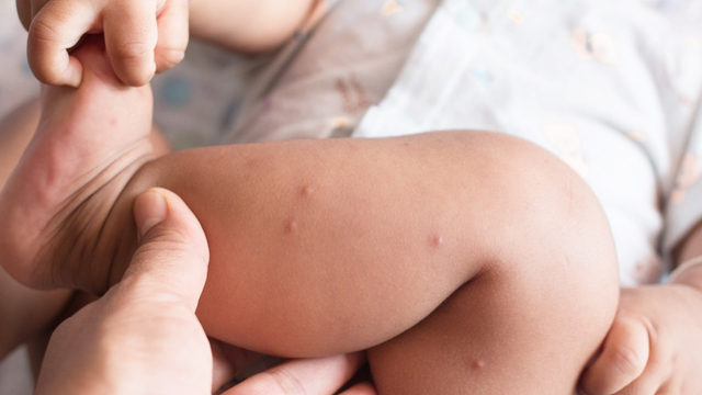 5 Jenis Alergi yang Kerap Jadi Masalah Kulit Bayi (156081)
