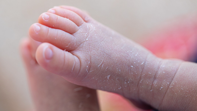 5 Jenis Alergi yang Kerap Jadi Masalah Kulit Bayi (156082)