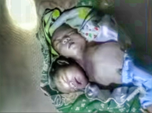 Keterangan foto: bayi kembar siam yang dilahirkan seorang ibu di Kabupaten Rote Ndao. Foto: istimewa.