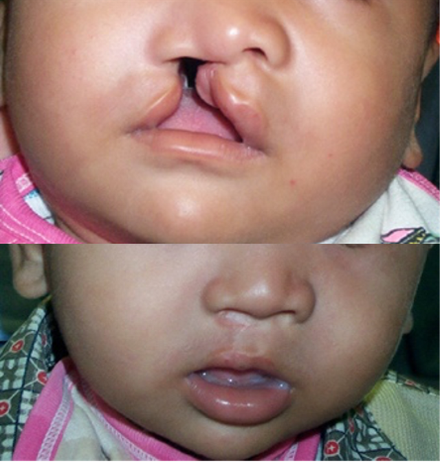 Seorang bayi dengan bibir sumbing sebelum dan setelah operasi (dr. RIK)