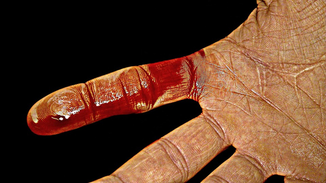 Penampakan kulit yang mengeluarkan darah saat terluka. Foto: Pixabay