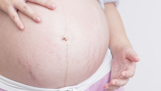 Penyebab Muncul Stretch Mark saat Hamil. Foto: Shutterstock