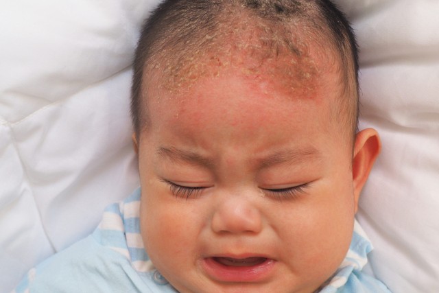 Ilustrasi cradle crap pada bayi. Foto: Shutterstock