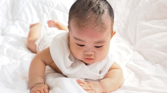 Tips Rawat Bayi dengan Kulit Kepala Kering. Foto: Shutterstock