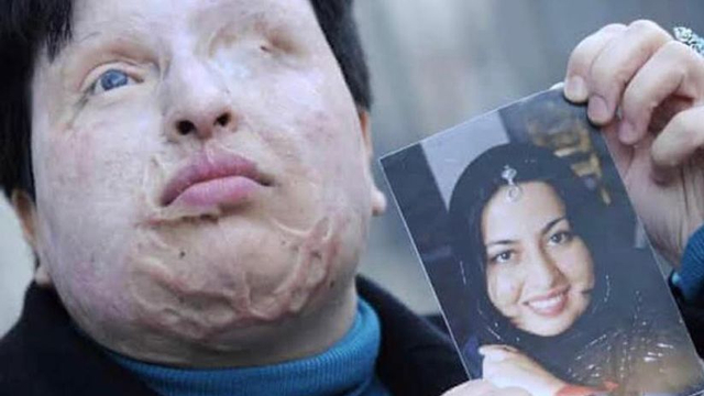 Wajah Ameneh Bahrami rusak dan matanya buta akibar siraman air keras yang dilakukan pacarnya. Foto: istimewa