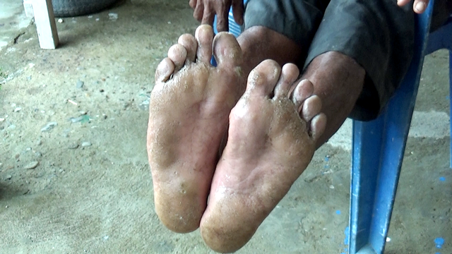 Kondisi kaki warga yang terserang penyakit kutu air. Foto: Dok banthayo