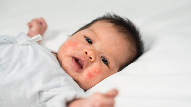 5 Hal yang Tidak Boleh Dilakukan Orang Tua saat Bayi Alami Eksim Foto: Shutterstock