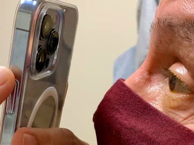 Foto mata pasien pakai kamera macro iPhone 13 Pro. Foto: Dok. dr. Korn via India Times
