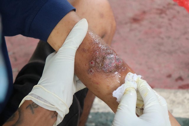 Proses pengobatan luka kudis pada warga binaan lapas Pemuda Madiun, Kamis(12/5/2022). (Foto: Humas Lasdaun)