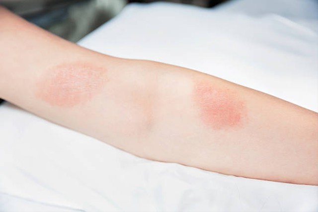 Scabies adalah penyakit kulit yang disebabkan oleh kutu kecil. Foto: Pixabay