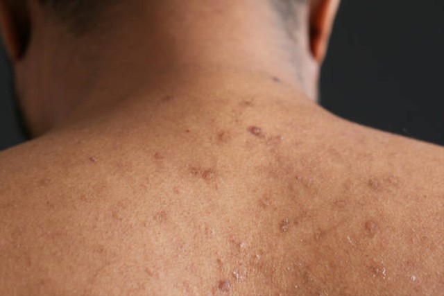 Pengertian Fungal Acne dan Perbedaannya dengan Bruntusan (30323)