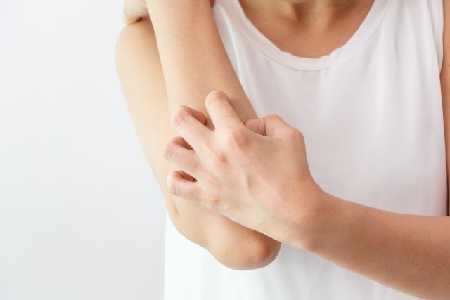 Gejala scabies menyebabkan gatal pada kulit. Foto: Pixabay