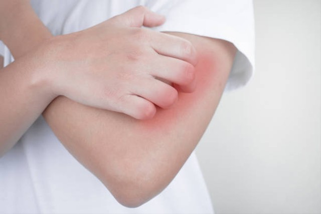Scabies adalah penyakit kulit yang menyebabkan gatal dan ruam kemerahan. Foto: Pixabay