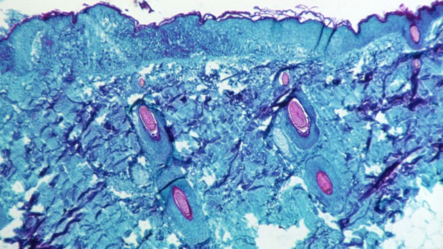 Bagian dari jaringan kulit, diambil dari lesi pada kulit monyet, yang telah terinfeksi virus monkeypox, terlihat pada pembesaran 50X pada hari keempat perkembangan ruam pada tahun 1968. Foto: CDC/Handout via REUTERS