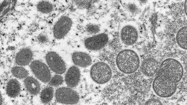 Gambar mikroskop elektron (EM) menunjukkan partikel virus monkeypox dewasa berbentuk oval serta partikel bulan sabit dan bulat dari virion yang belum matang, diperoleh dari sampel kulit manusia. Foto: Reuters