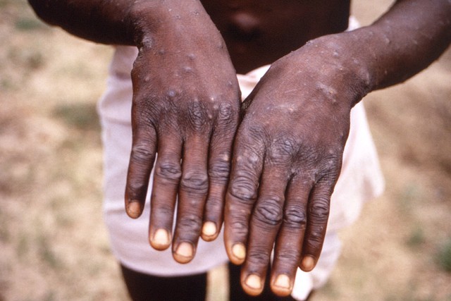 Sebuah gambar yang dibuat selama penyelidikan wabah cacar monyet, yang terjadi di Republik Demokratik Kongo (DRC), 1996 hingga 1997, menunjukkan tangan seorang pasien dengan ruam akibat cacar monyet. Foto: Reuters
