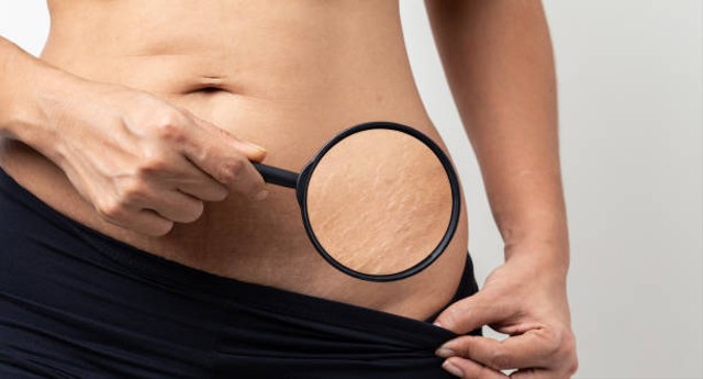 Penyebab Stretch Mark. Foto: iStockphoto