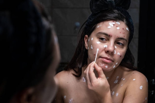 Krim Retinol untuk Bekas Cacar. Foto: iStockphoto