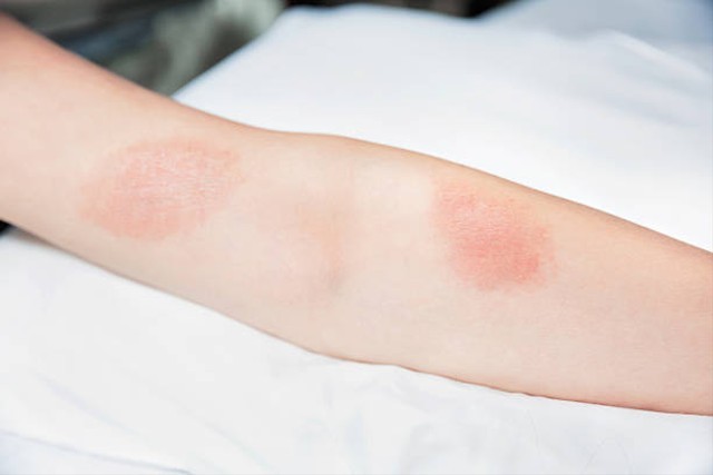 Apa ciri-ciri herpes akan sembuh? Foto: Pixabay