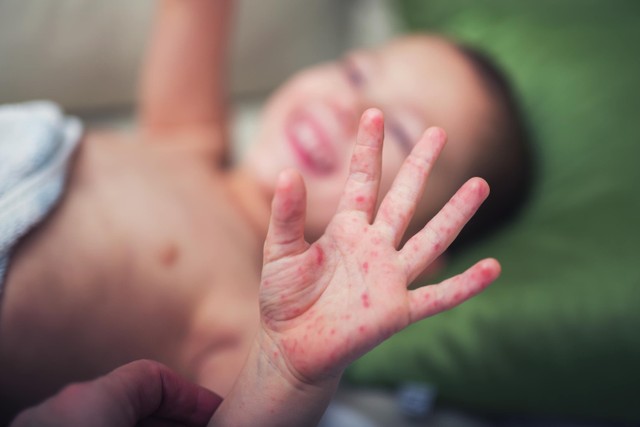 Ilustrasi Anak Kena Flu Singapura atau Penyakit Tangan, Kaki, Mulut (PTKM). Foto: Shutterstock