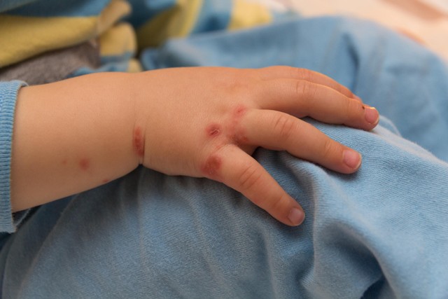 Ilustrasi Anak Kena Flu Singapura atau Penyakit Tangan, Kaki, Mulut (PTKM). Foto: Shutterstock