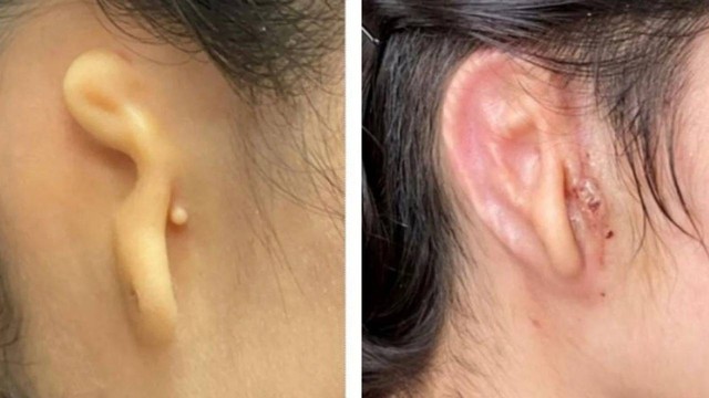 3DBio Therapeutics menciptakan implan telinga cetak 3D. Foto: Dok. 3DBio Therapeutics 