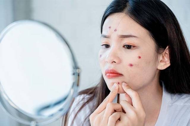 Kulit berjerawat, Foto: Dok. Shutterstock