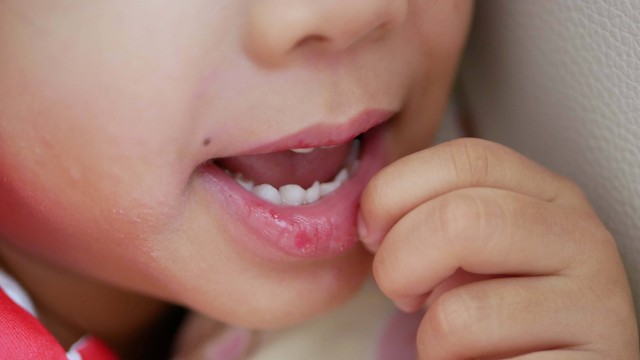 Anak mengupas kulit bibirnya. Foto: Ole.CNX/Shutterstock