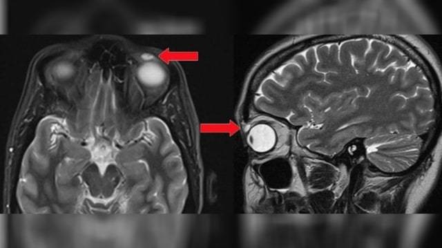 Hasil pemindaian MRI temukan lensa kontak berusia 28 tahun di kelopak mata seorang perempuan. (Foto: Sirjhun Patel via BMJ Case Reports)
