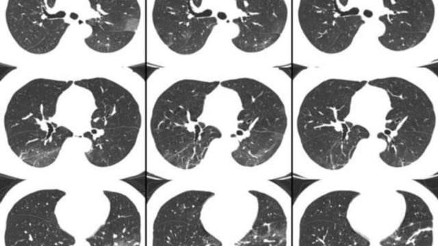 Gambar CT Scan dari seorang pria berusia 44 tahun yang mengalami demam selama 4 hari akibat virus corona. Foto: Tao Ai et al/RSNA
