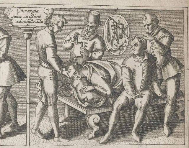 Praktik trepanation atau melubangi kepala pada jaman dulu. Foto: Wellcome Library