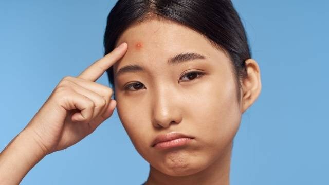 Ilustrasi kulit berjerawat. Foto: Shutterstock