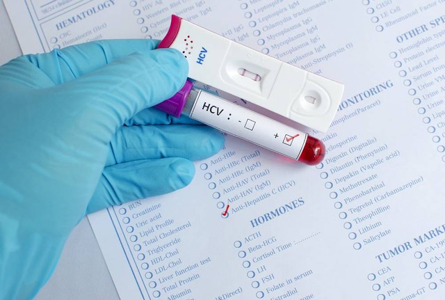 Ilustrasi pemeriksaan Hepatitis C . Foto: Jarun Ontakrai/Shutterstock