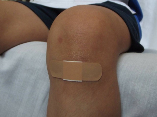 Ilustrasi cara menghilangkan bekas koreng di kaki. Foto: Unsplash