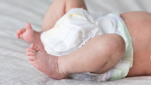 Ilustrasi kulit bayi baru lahir mengelupas. Foto: UvGroup/Shutterstock