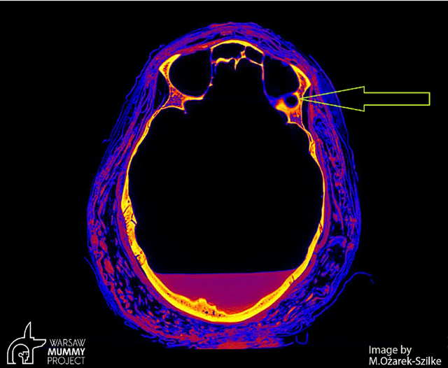 Panah kuning menunjukkan perubahan yang disebabkan oleh tumor, mungkin situs metastasis pada Mumi wanita hamil. Foto: Warsaw Mummy Project