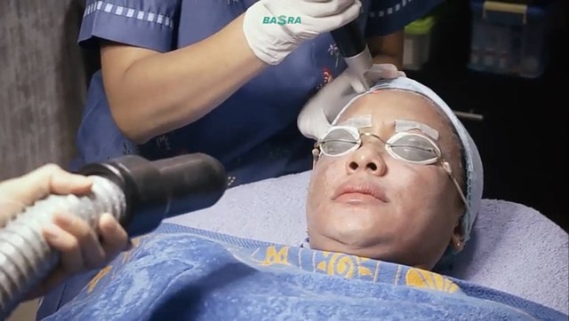 Perawatan Melasma dengan Laser PICO di Surabaya Skin Centre