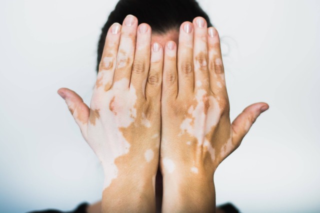 Ilustrasi perempuan vitiligo. Foto: Shutterstock