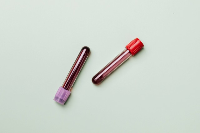 Salah satu cara mengukur asam urat adalah tes asam urat dalam darah. Foto: Pexels.com