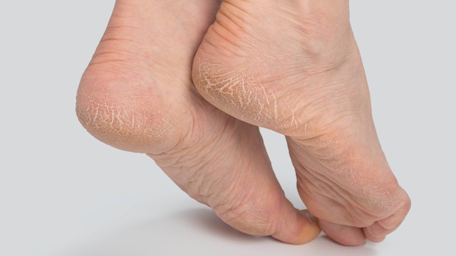 Ilustrasi tumit kaki pecah-pecah.  Foto: CeltStudio/Shutterstock.