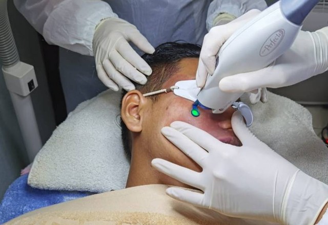 Menghilangkan tanda lahir merah dengan metode laser yang aman di Surabaya Skin Centre. Foto: Dok. Surabaya Skin Centre