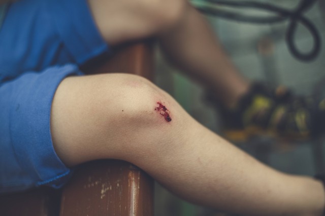 Bagaimana cara menghilangkan bekas luka di kaki yang ampuh? Foto: Unsplash